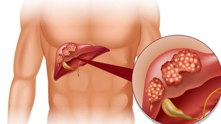 Uống nước cây cà gai leo có tác dụng gì? Uống nước cây cà gai leo có tác dụng gì?