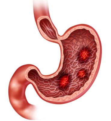 Nguyên nhân của bệnh đau dạ dày