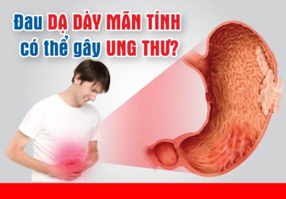 Thông tin về bệnh đau dạ dày