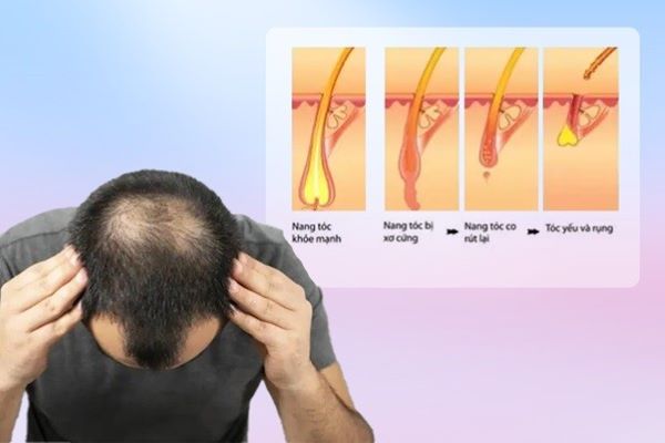 Tình trạng tóc rụng nhiều là do đâu