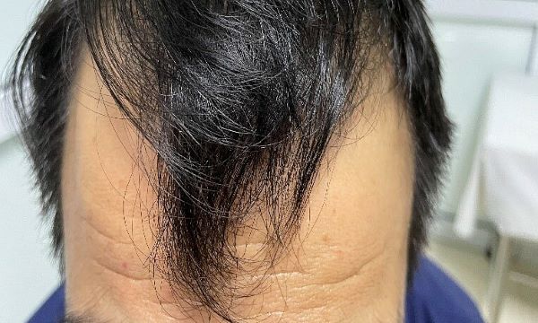 Chữa tóc thưa, tóc bạc sớm bằng Hà thủ ô