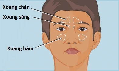 Đối tượng hay mắc bệnh viêm xoang