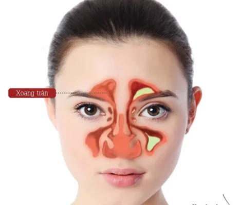 Bệnh viêm mũi dị ứng là gì?