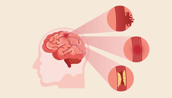 Cách phòng tránh đột quỵ
