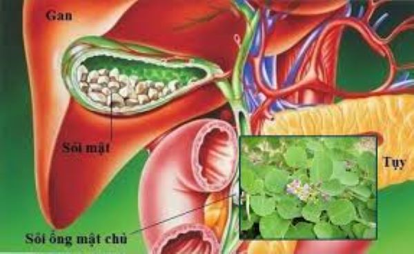 Cây Kim tiền thảo có chữa được sỏi thận không?