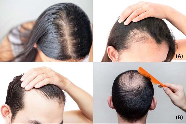 Cao chiết hà thủ ô có tác dụng gì với tình trạng tóc thưa, gãy rụng nhiều