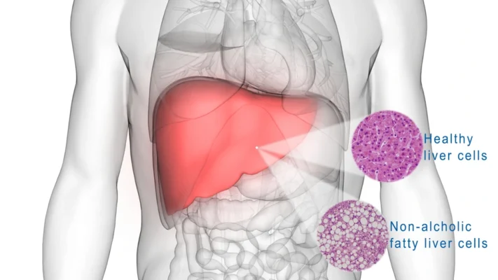 Bệnh gan nhiễm mỡ thì nên uống gì?