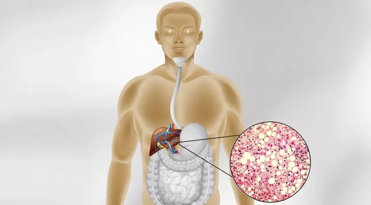 Cách phòng tránh bệnh gan nhiễm mỡ