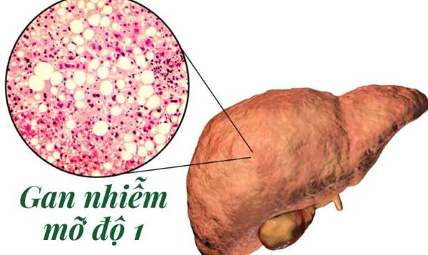 Bài thuốc chữa gan nhiễm mỡ từ dân gian