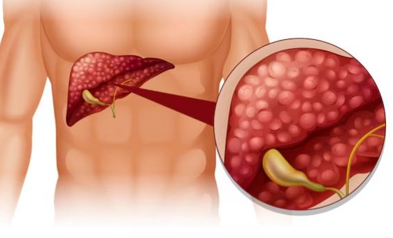 Bệnh gan nhiễm mỡ có nguy hiểm không?