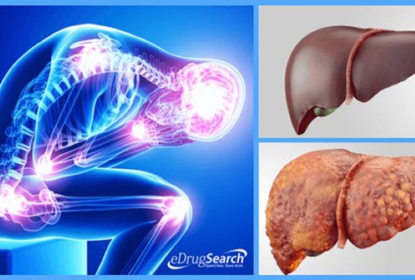 Bệnh gan nhiễm mỡ nên kiêng gì?