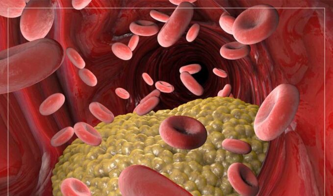 Bệnh máu nhiễm mỡ có nguy hiểm không?