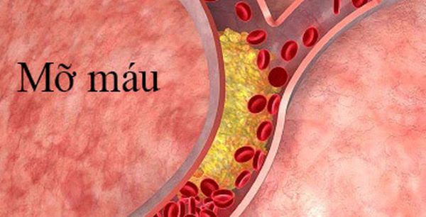 Bệnh máu nhiễm mỡ có thể gây ra những biến chứng gì?