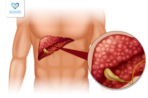 Tác hại của bệnh gan nhiễm mỡ