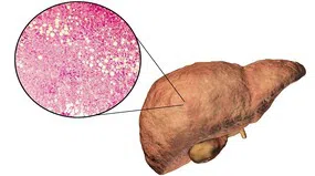 Triệu chứng của bệnh gan nhiễm mỡ