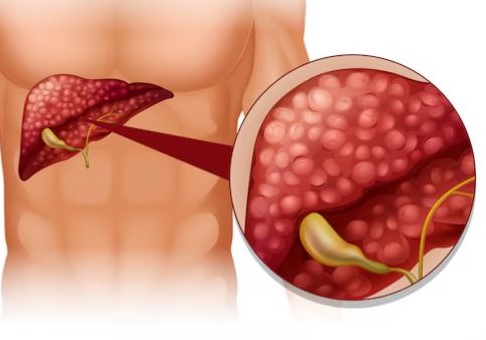 4 dấu hiệu gan nhiễm mỡ dễ nhận biết