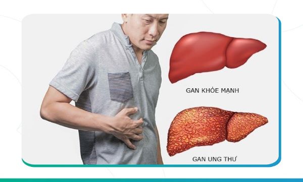 7 điều nên nhớ để bảo vệ lá gan của bạn